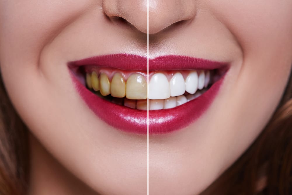 Benefits of Professional Dental Cleanings - Remove Stains