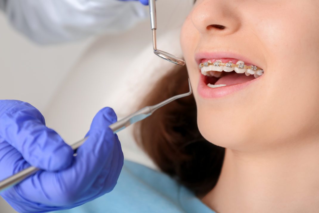 Common Dental Treatments - braces